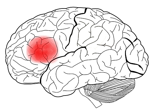 Illustration showing the location of a brain tumour